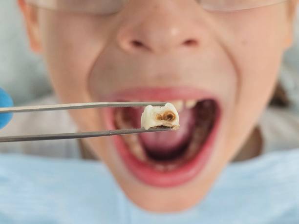 Best Broken or Cracked Tooth Emergency Dentist in Forest Park, OH